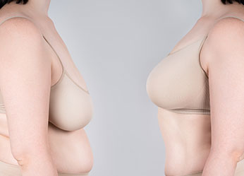 Image showing Breast fat enlargement