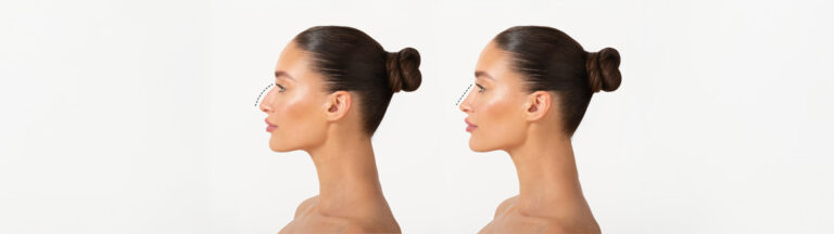 Best Rhinoplasty Surgeon in Pune