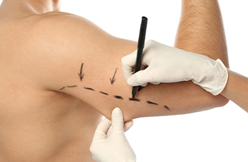 Brachioplasty Surgery